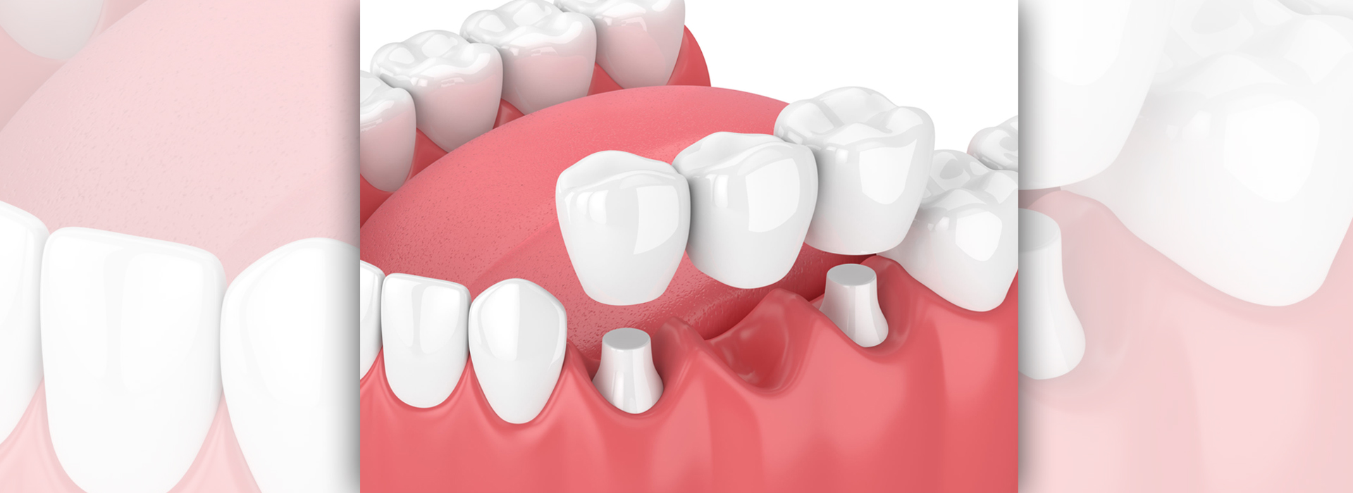 Crown & Bridge for Replacement of Teeth