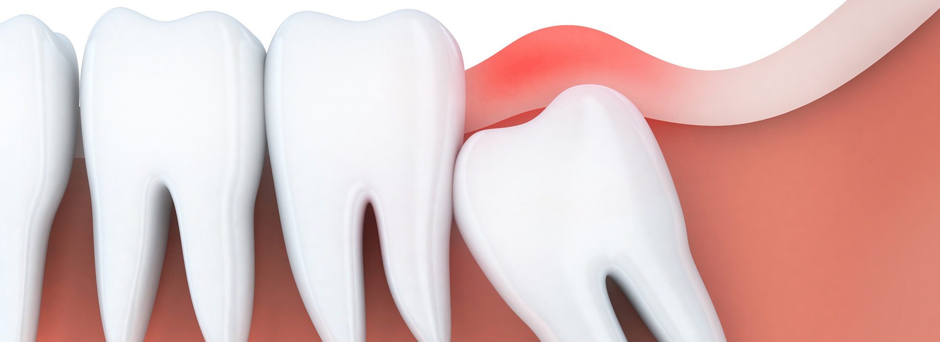 Tooth extraction & Surgical Wisdom Tooth Removal