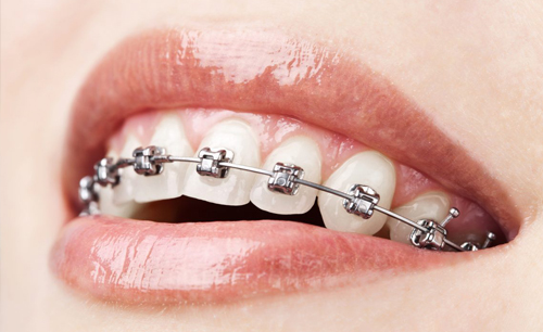 Braces Treatment (Orthodontia)