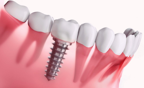 Dental Implants