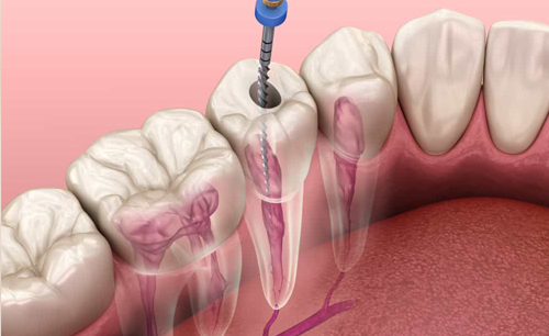 Root canal Treatment