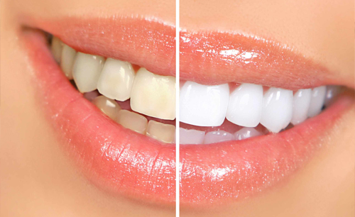 Teeth Whitening