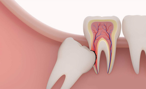 Tooth extraction & Surgical Wisdom Tooth Removal